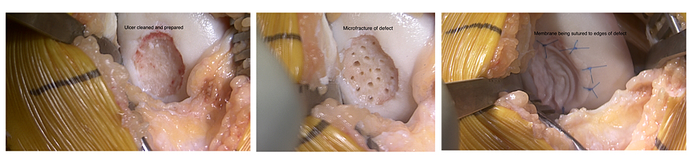 chondral knee damage repairing techniquesAutologous Induced Chondrogenesis case showing autologous induced chondrogenesis